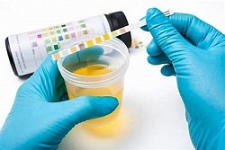 urine analysis